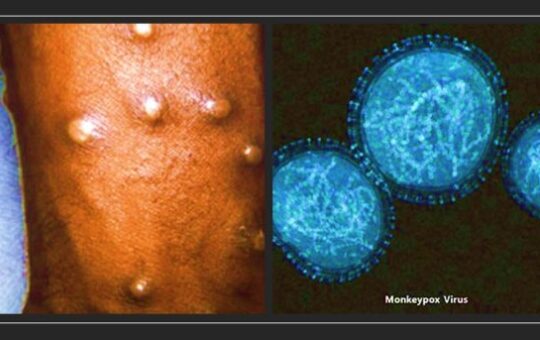 इस वजह से दुनियाभर में बढ़े मंकीपॉक्स के केस, वैज्ञानिकों ने किया खुलासा